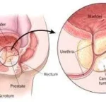ICD-10 prostate cancer