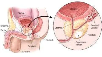 ICD-10 prostate cancer