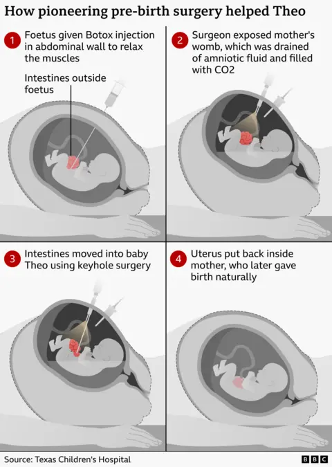 Texas Children’s Hospital Infographic showing a four-step prenatal surgery. The foetus is given a Botox injection in the abdominal wall to relax the muscles, surgeons temporarily open the womb and use keyhole surgery to move a foetus’s intestines back inside the body before returning the uterus, allowing the pregnancy to continue until the healthy baby is born naturally.